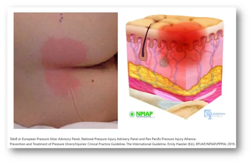 Pressure sore prevention - Consequences, stages and classification ...