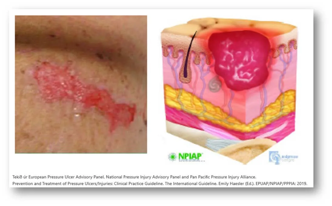 Pressure sore prevention - Consequences, stages and classification ...