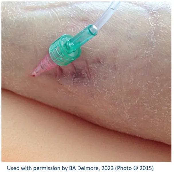 Á myndinni er lítið læknistæki sem hefur legið upp við húð og valdið þrýstingsskaða