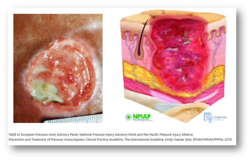 Deep Injuries Pressure sore prevention - Consequences, stages and classification ...