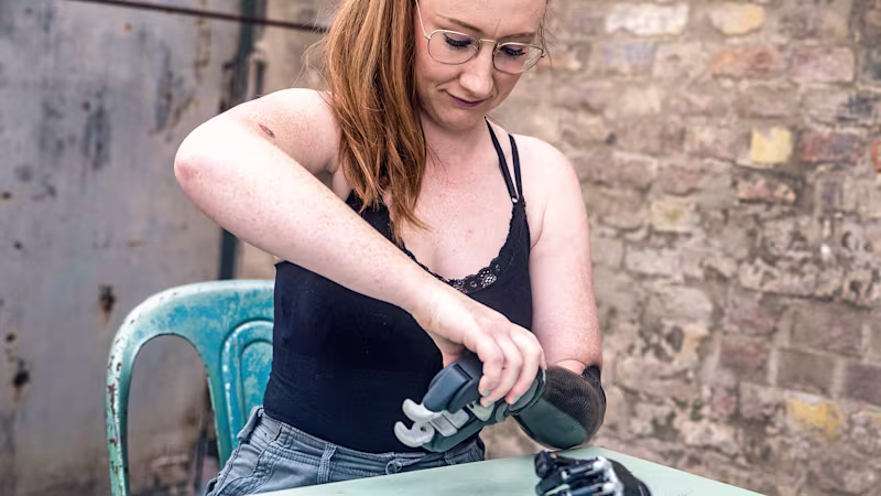 Enya is putting on her Ottobock bebionic hand.