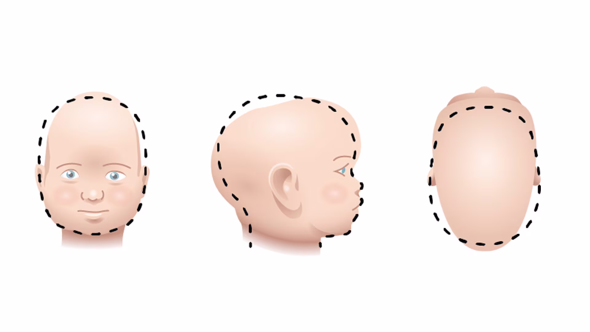 Illustrations of baby’s head shape with Scaphocephaly from 3 perspectives
