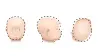 Illustrations of baby’s head shape with Plagiocephaly from 3 perspectives