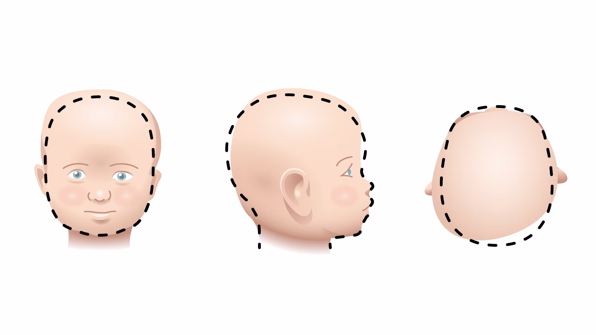 Illustrations of baby’s head shape with Asymmetrical Brachycephaly from 3 perspectives