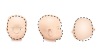 Illustrations of baby’s head shape with Asymmetrical  Brachycephaly from 3 perspectives