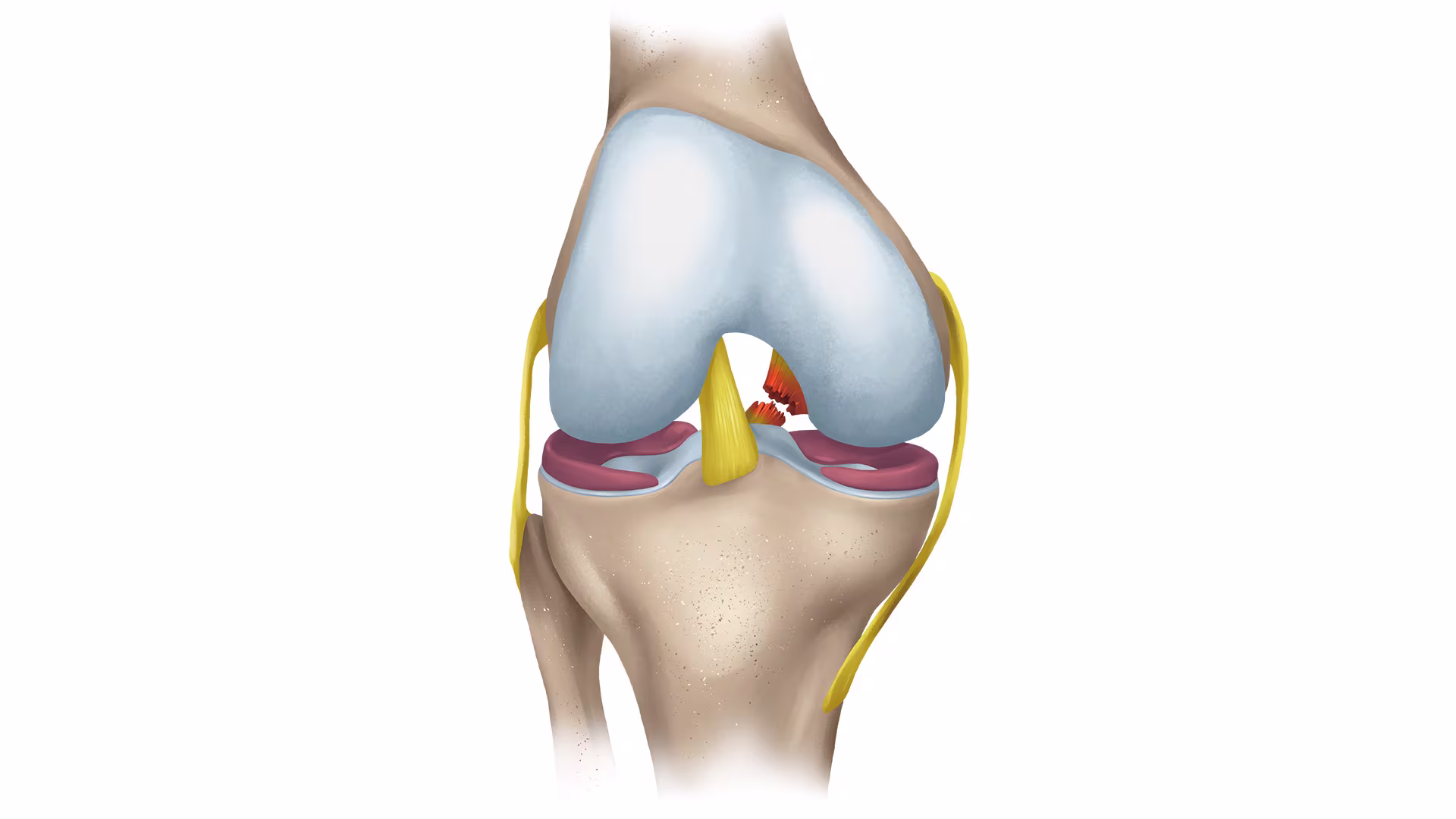 Ruptur des hinteren Kreuzbandes