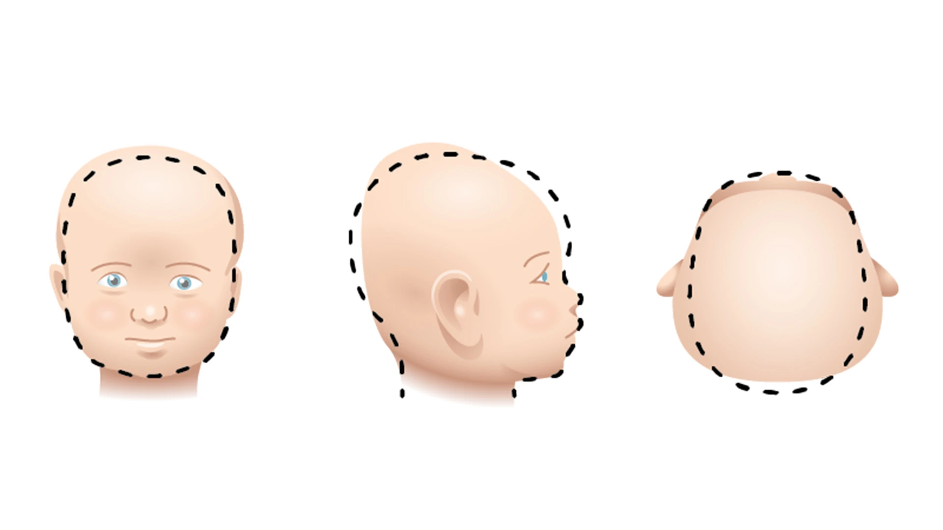 Plagiocefalie Plagiocephalie | Plat Achterhoofd | Mimos® Babykussen Plagiocefalie Plagiocephalie | Plat Achterhoofd | Mimos® Babykussen