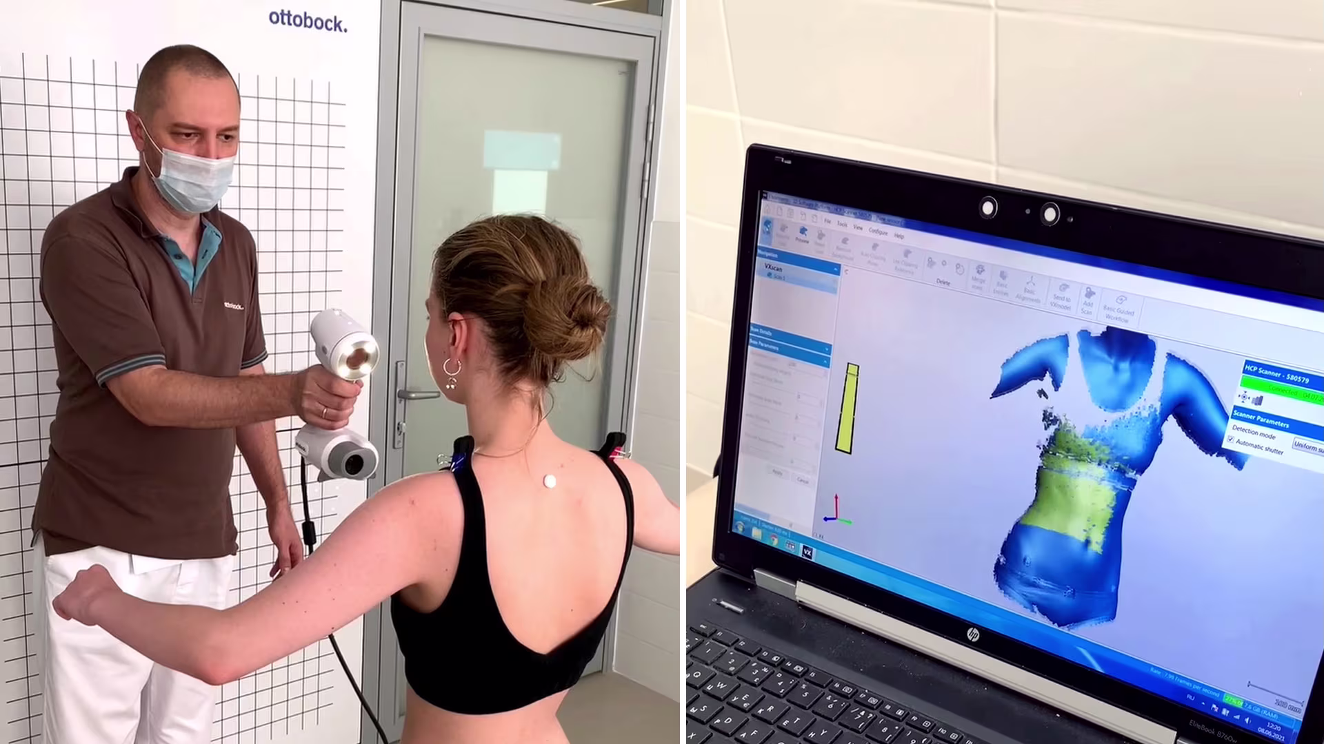 Сканирование туловища пациента при изготовлении корсета по методике Шено