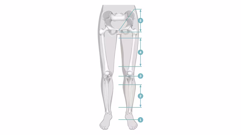 Graphic showing a schematic lower body with bones illustrated and amputation levels marked