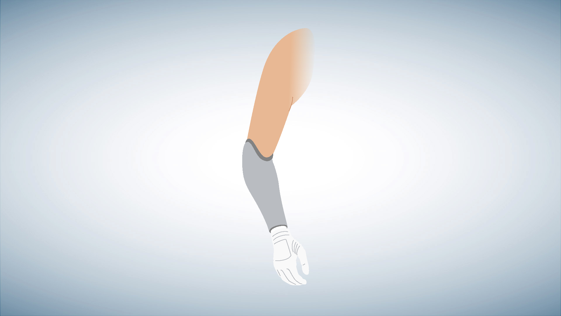 Schematic illustration of a below-elbow prosthesis.