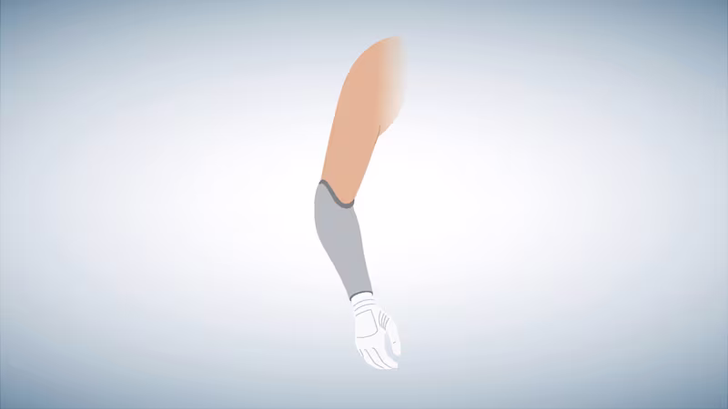 Schematic illustration of a below-elbow prosthesis.