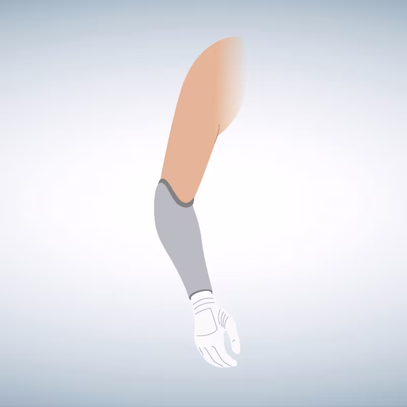 Schematic illustration of a below-elbow prosthesis.