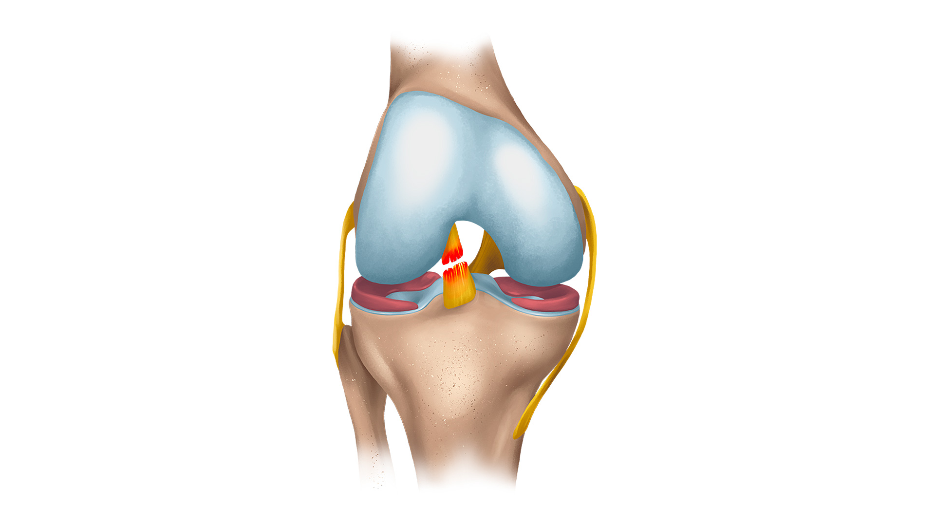 Jak se projevují přetržené vazy v koleni?