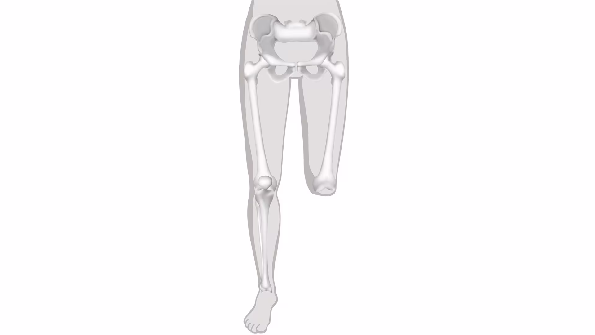 義足 切断レベル 大腿義足/膝義足 膝離断