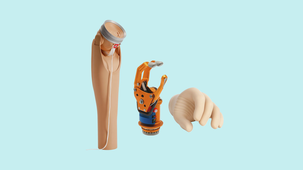 Hier werden für einen Armprothesenträger das DynamicArm-Ellbogengelenk mit der VariPlus Speed Hand von Ottobock gezeigt.