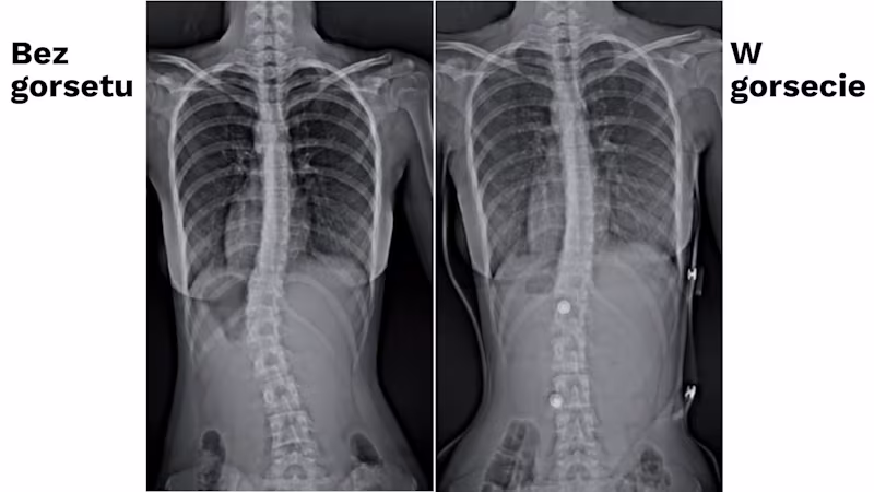 Kopia – leady gorset 1x1 nowy NFZ (1600 x 900 px) (3)