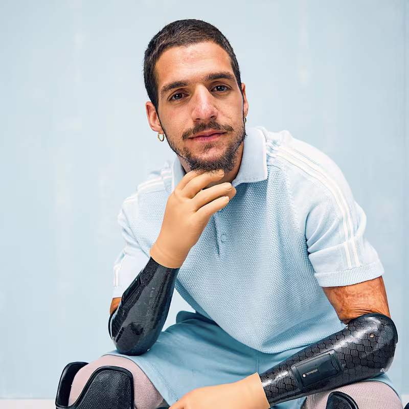 Ein Armprothesenträger sitzt auf einem Stuhl und sieht nachdenklich aus. Er trägt die VariPlus Speed Hand von Ottobock