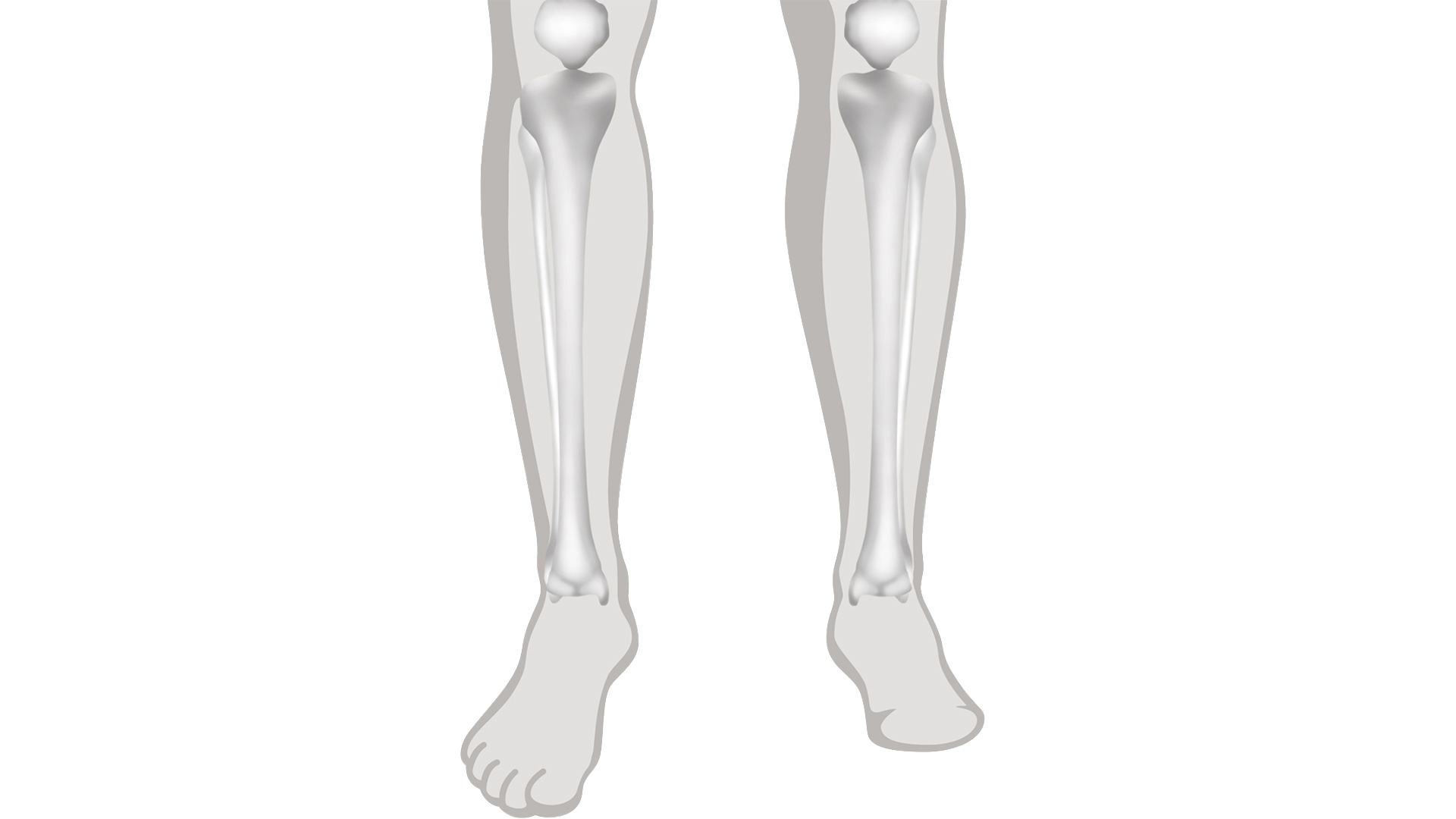 Disegno per informazioni su amputazione del piede 
