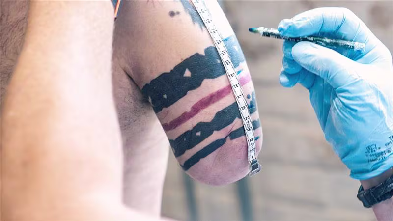 Residual upper limb being measured for the fitting of a custom Ottobock prosthesis.