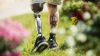 Prosthetic user with C-Leg is walking