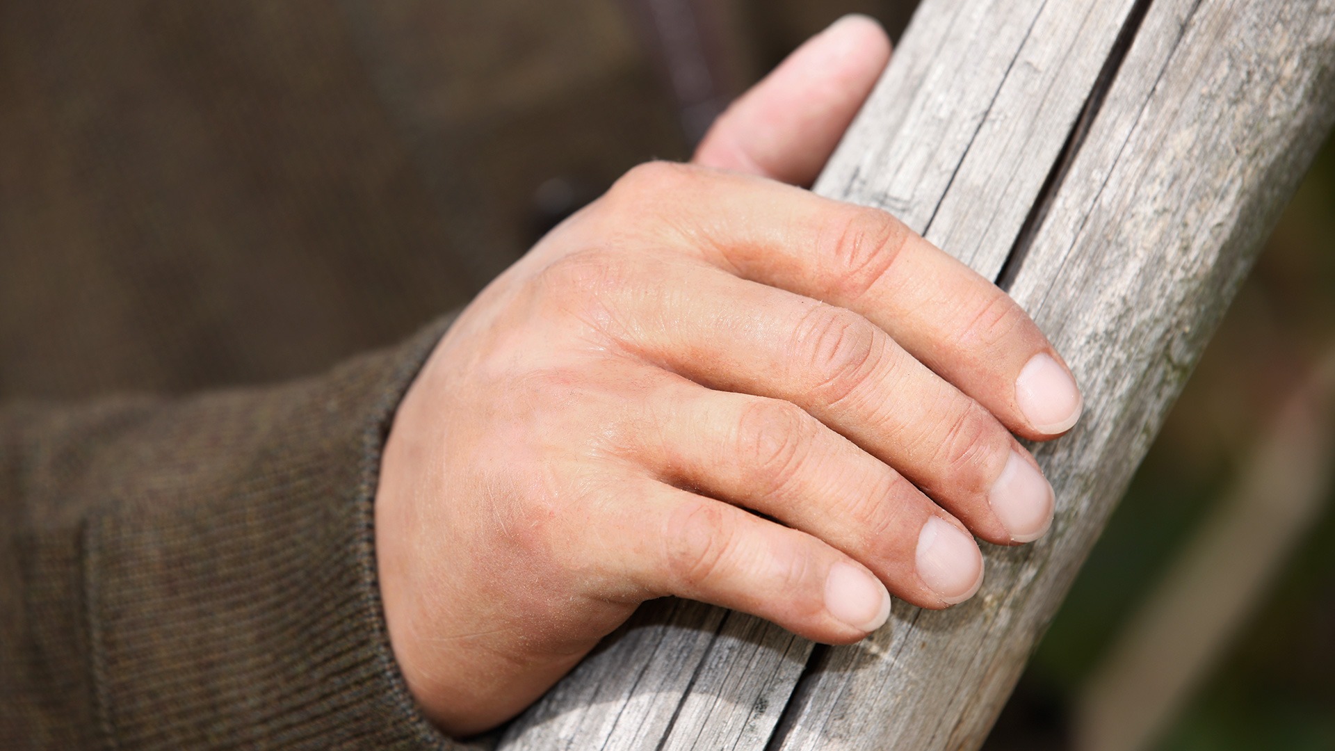 Mano parcial protésica de silicona personalizada.