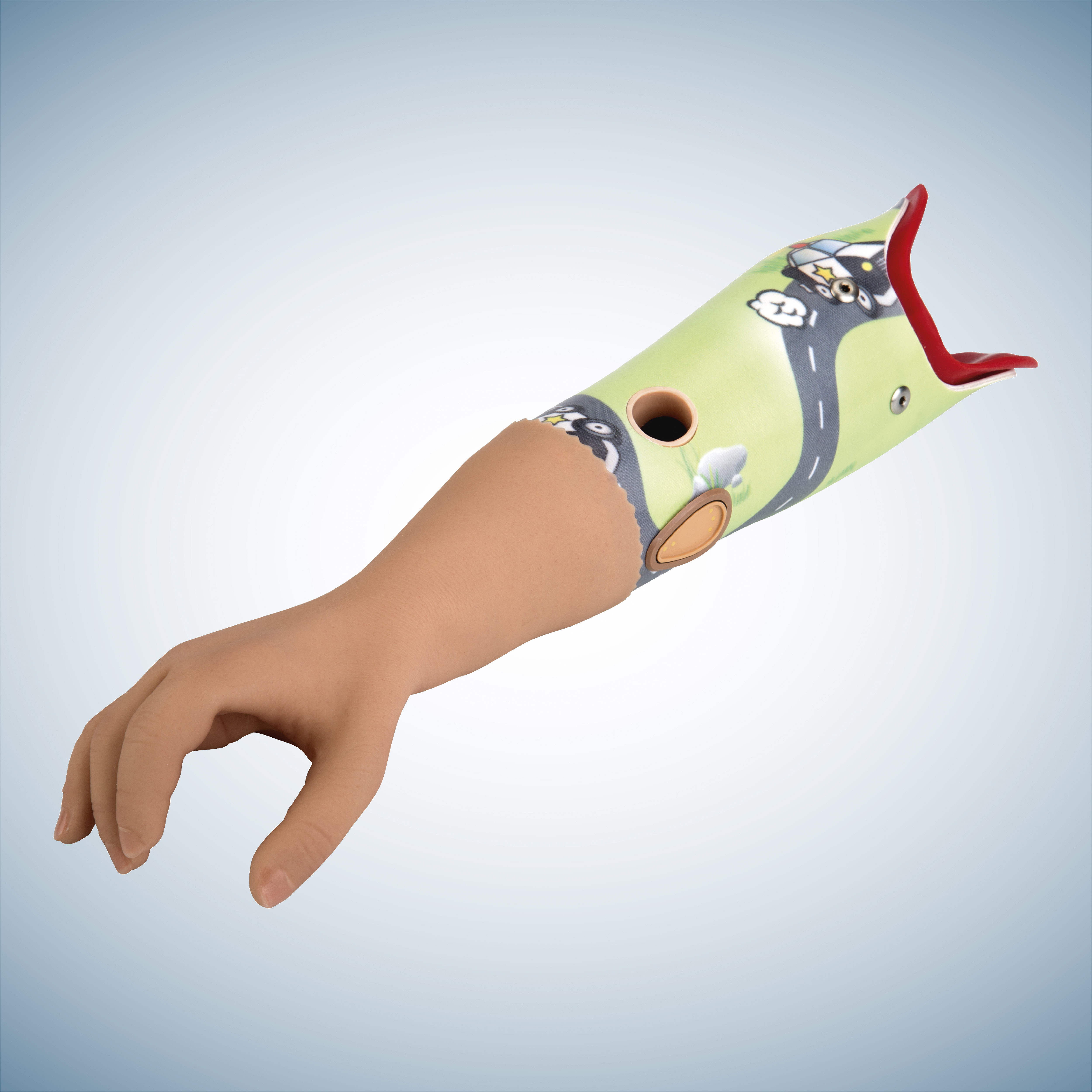 Below-elbow child prosthesis: Ottobock Electric Hand 2000 and MyolinoWrist 2000.