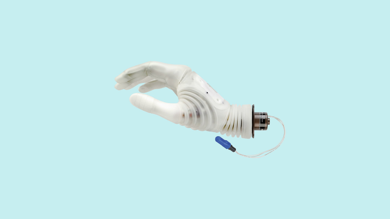 Hier werden die Michelangelo Hand und das Axon Bus Prothesensystemvon Ottobock für einen Armprothesenträger gezeigt.