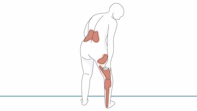 A dawn figure depicting a person facing the other direction with the lower back, and entire leg highlighted in a different color to emphasize pain