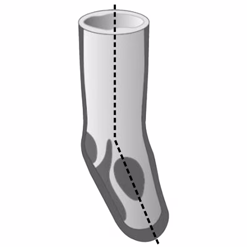 義足ライナー 6Y78下腿用3Dシリコーン抗菌加工 ピン懸垂 20度屈曲角度 骨突起クッション