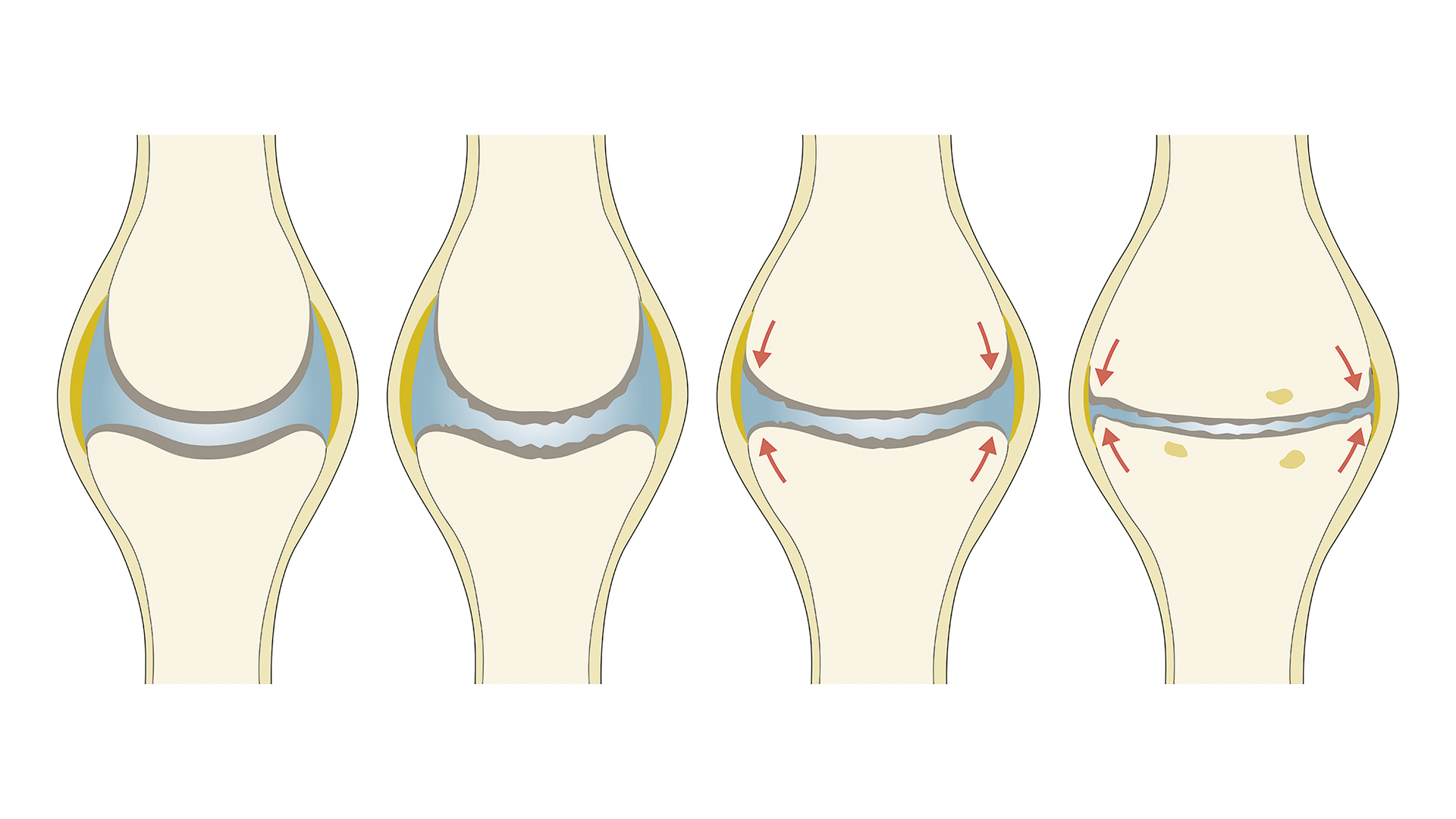 Šta je osteoartritis koljena i koji su njegovi uzroci, znaci i simptomi - Lijek - 