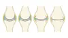 Рисунок, демонстрирующий стадии развития артроза коленного сустава.
