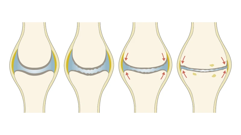 osteoartritis 1. i 2. stupnja liječenja stopala)