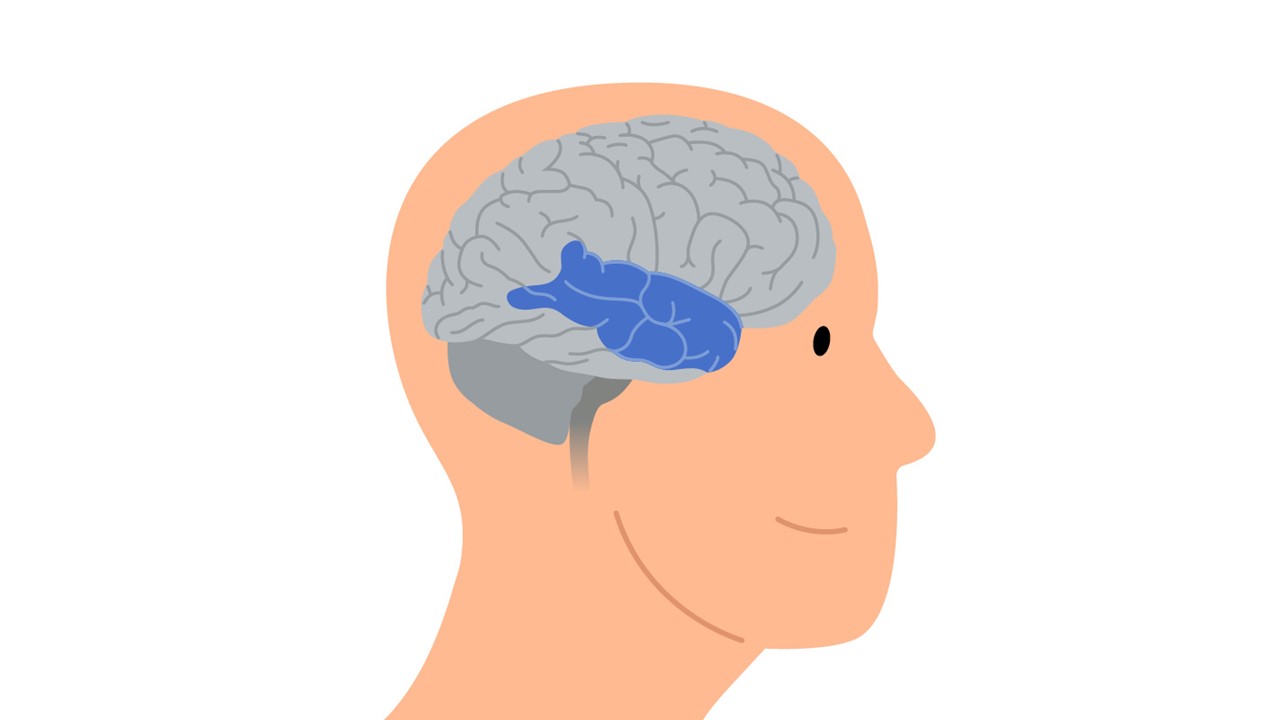 Graphic of a human head and brain in which the areas of the brain affected by Dyskinesia are highlighted in blue