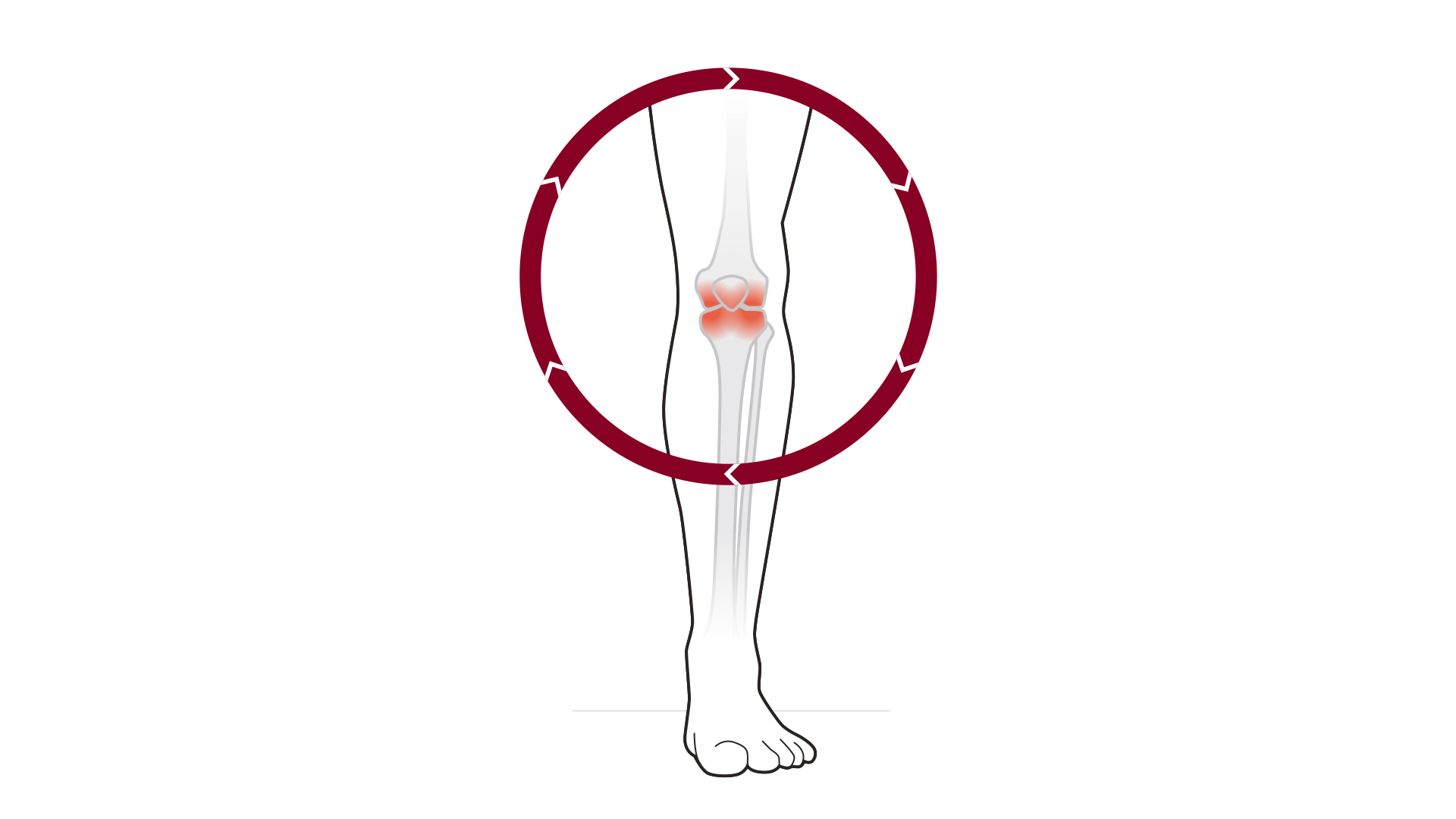 liječenje osteoartritisa nakon ozljede injekcije za jaku bol u zglobu koljena