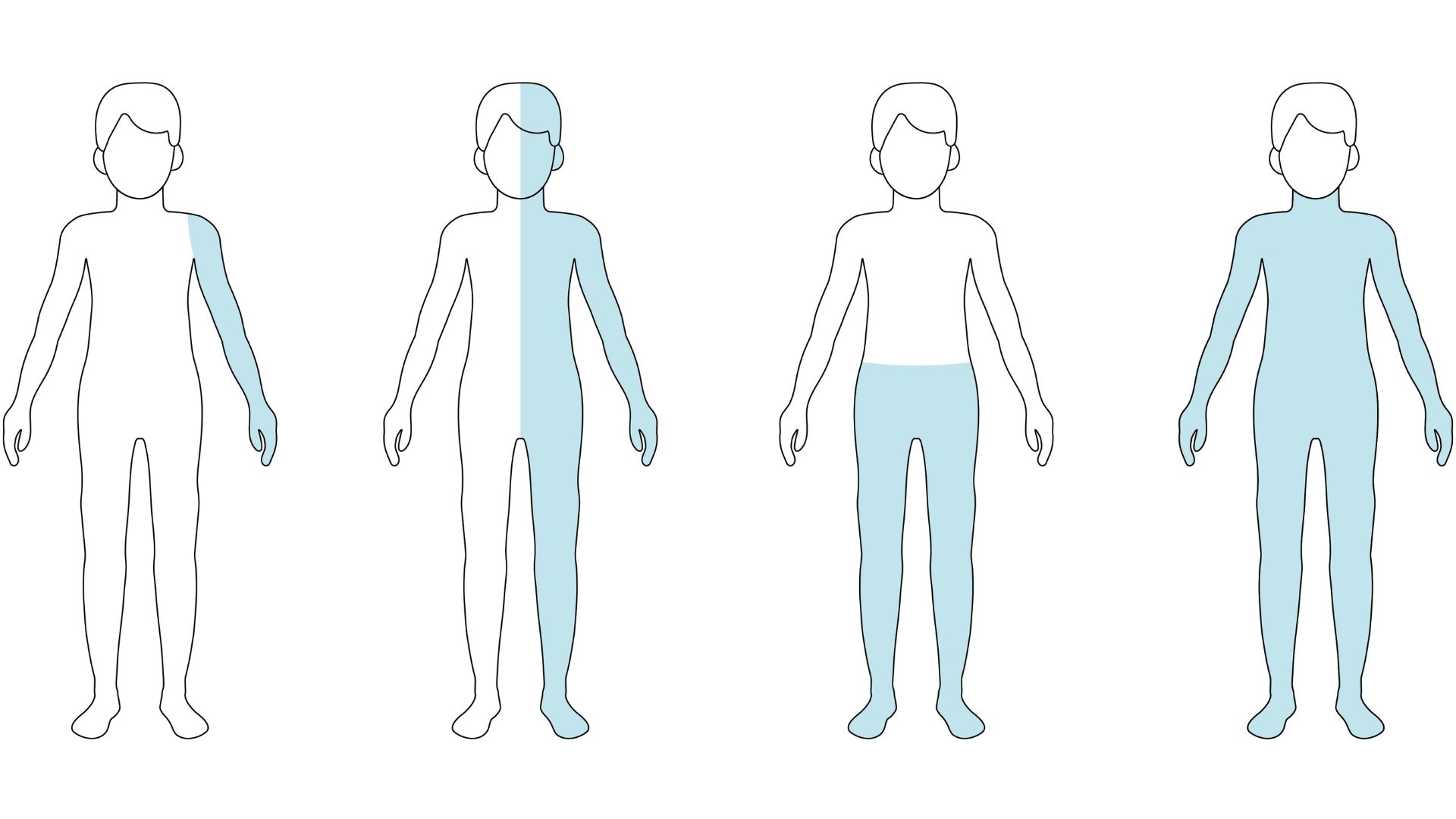 Farklı felç biçimlerinin grafiksel gösterimi