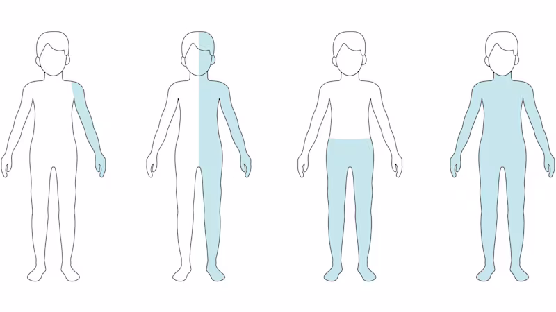 Farklı felç biçimlerinin grafiksel gösterimi