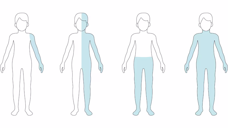Graphic representation of different forms of paralysis