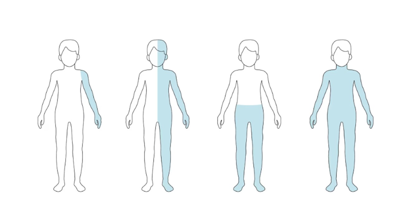 Grafické znázornenie rôznych foriem paralýzy