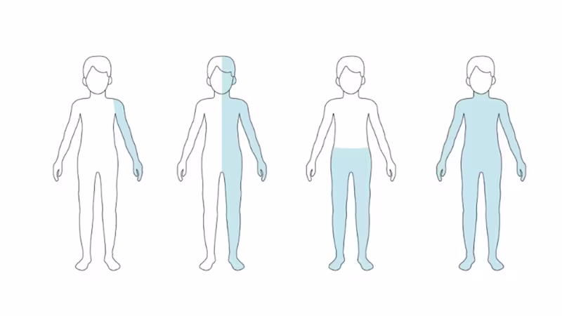 Grafické znázornenie rôznych foriem paralýzy