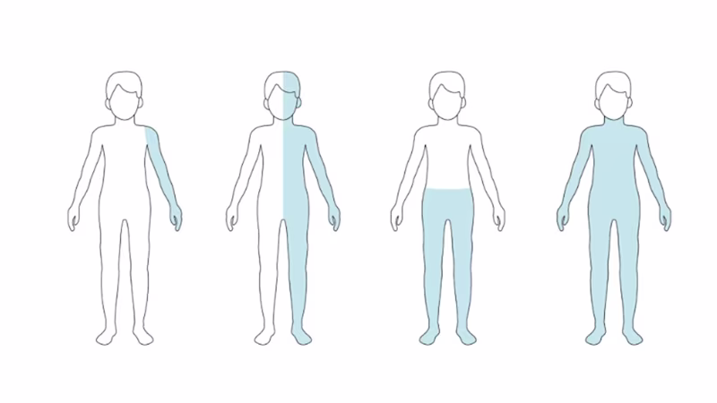 Graphic representation of different forms of paralysis