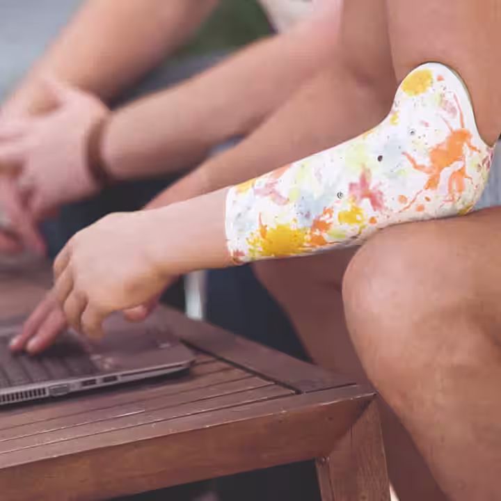 Un amputé d’un membre supérieur portant une prise transradiale SiOCX, faite sur mesure par Ottobock