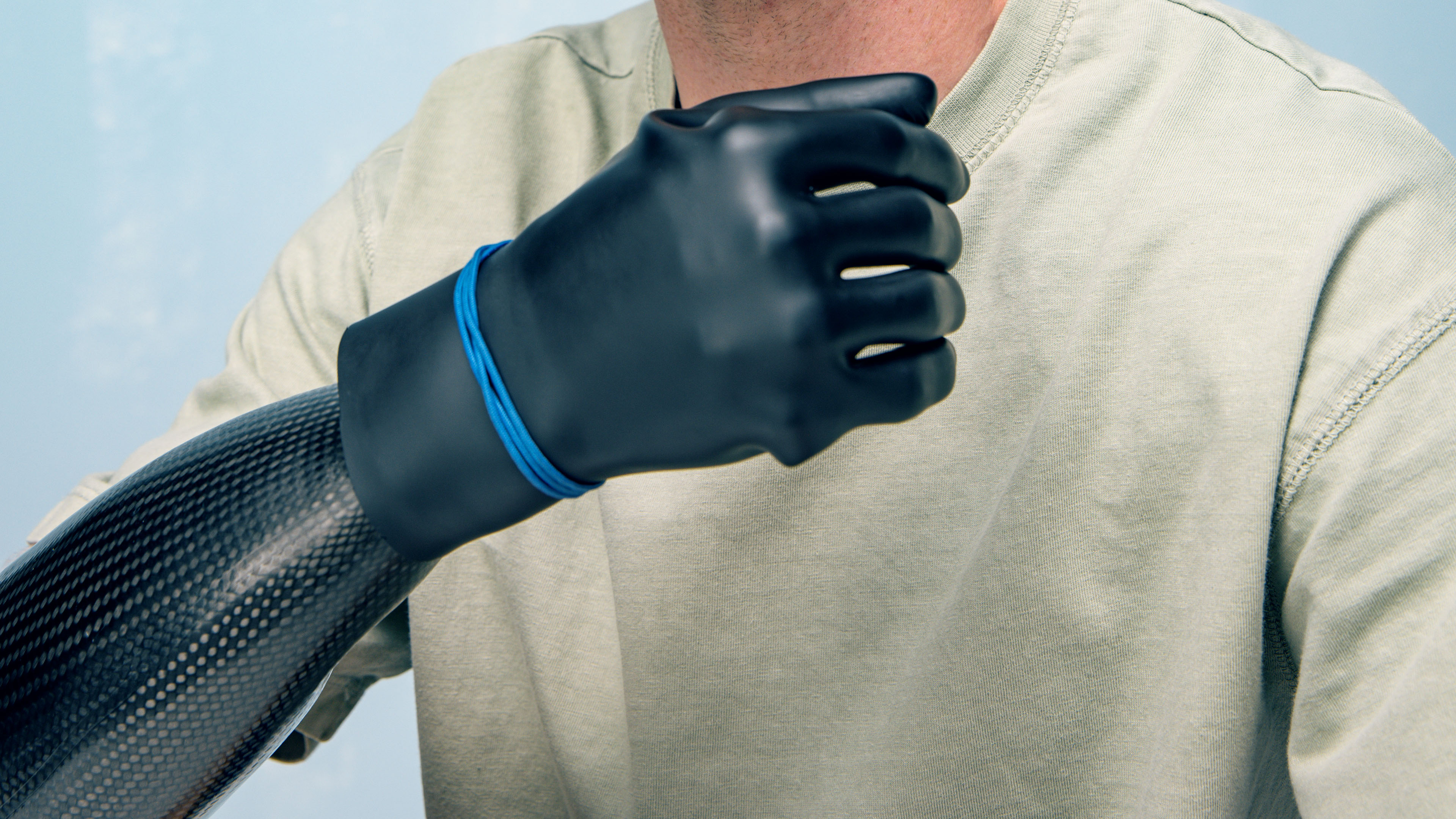 An upper limb amputee wearing the Michelangelo prosthetic hand by Ottobock