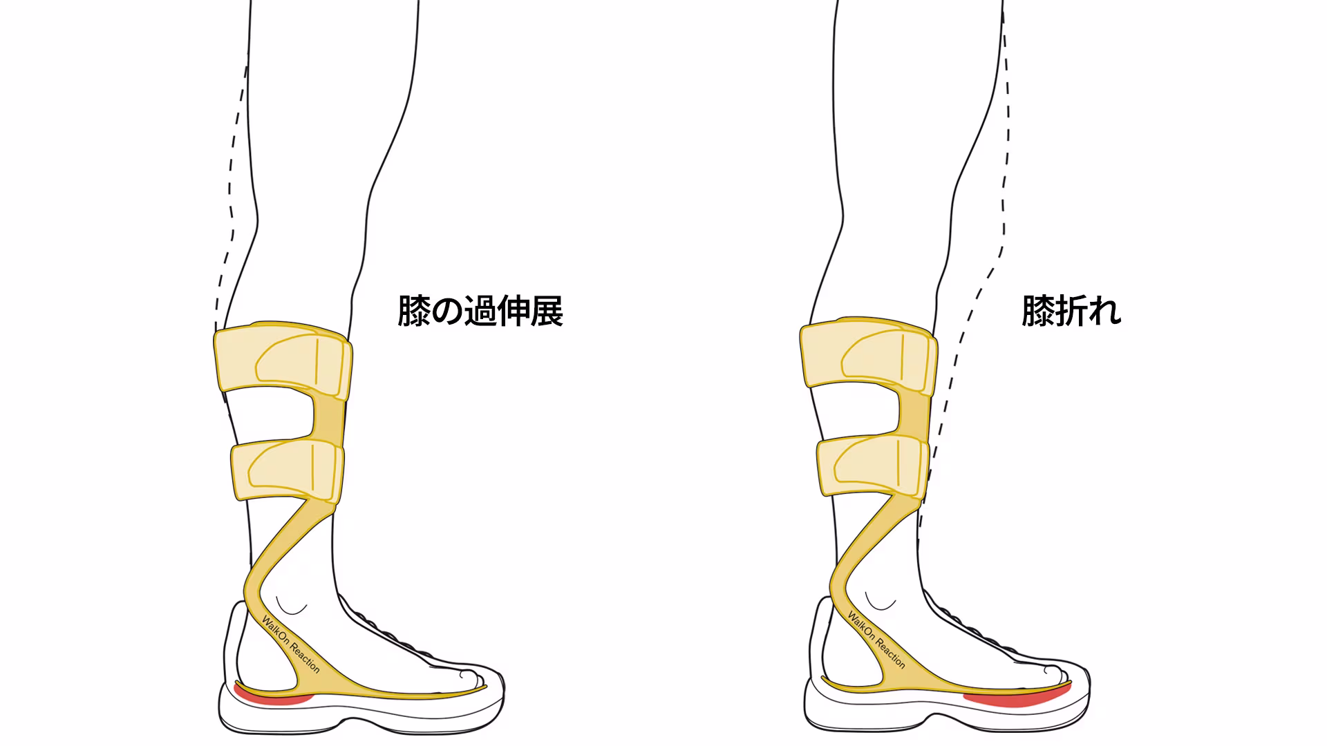 カーボン製短下肢装具ウォークオン