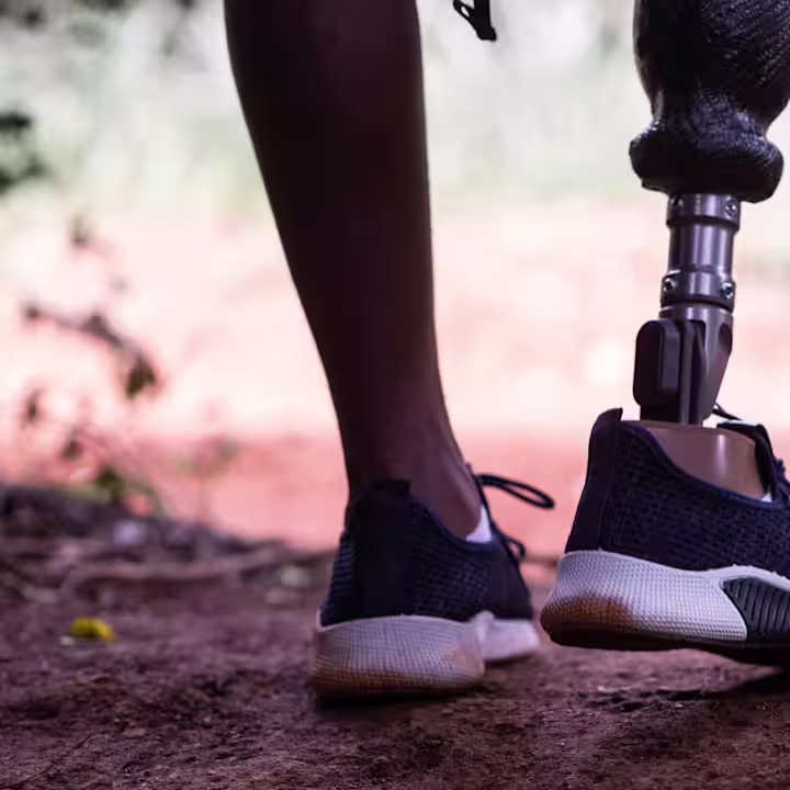 Kenya prosthetic feet Jack
