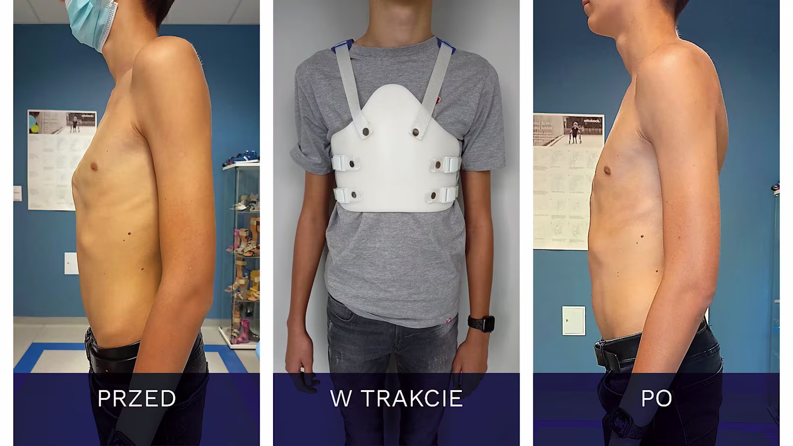 GORSET WILMINGTON Kurza klatka piersiowa Pectus Carinatum