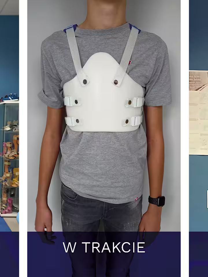 GORSET WILMINGTON Kurza klatka piersiowa Pectus Carinatum