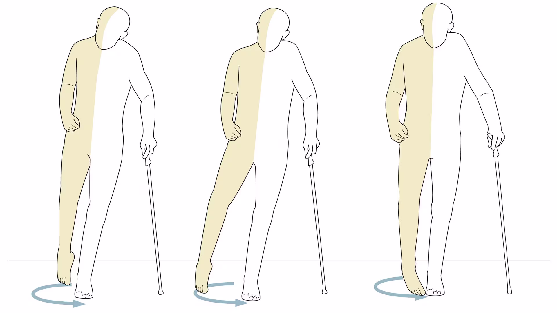 Fußheberschwäche im Fokus