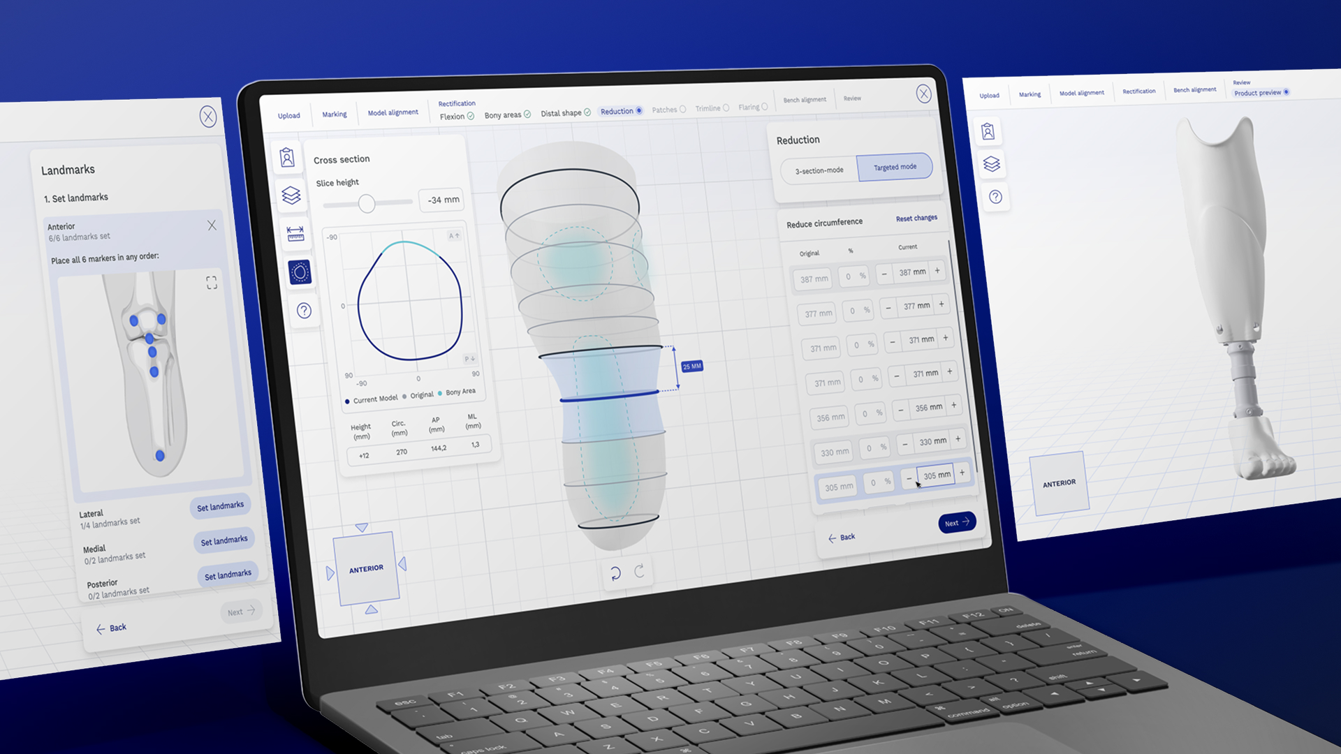 Laptop displaying CADkit software during the transtibial socket design process.