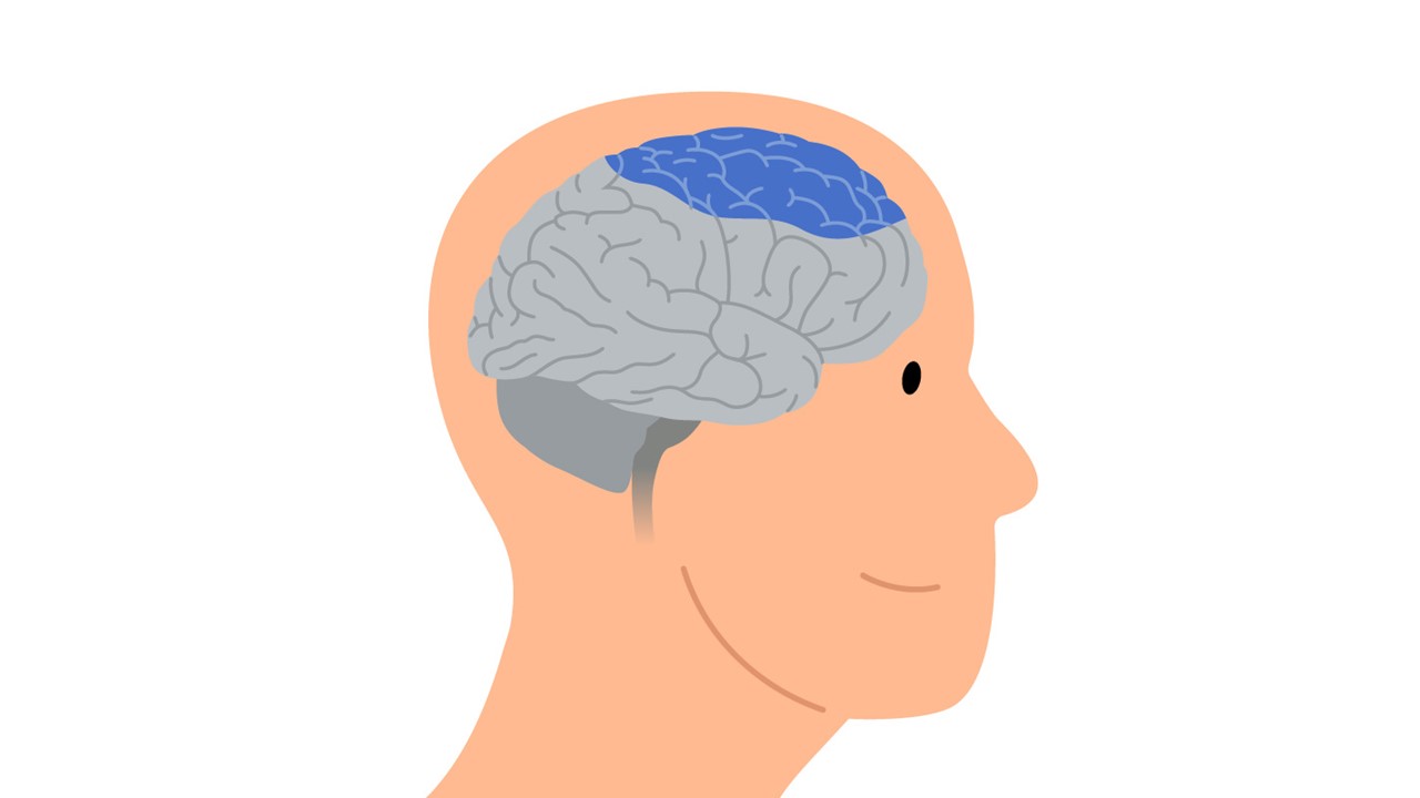 Graphic of a human head and brain in which the areas of the brain affected by spastic paralysis are highlighted in blue