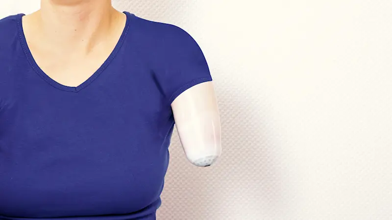 An amputee wearing a blue t-shirt and a silicone liner covering their residual limb